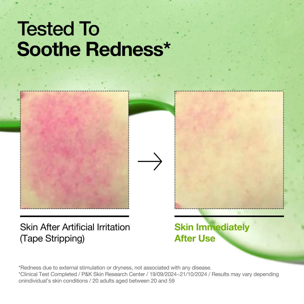 Anua Azelaic Acid 10 Hyaluron Redness Soothing Serum Anua